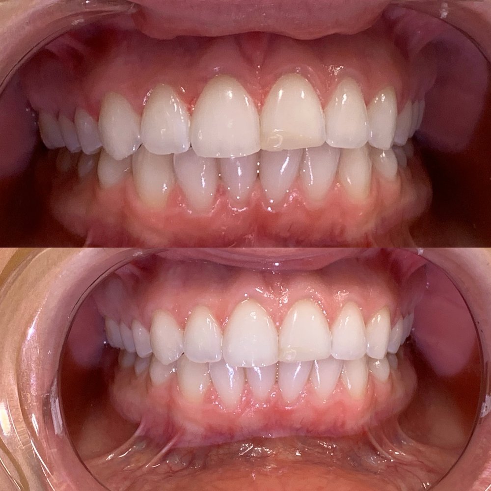 Top photo: original teeth color  Bottom photo: after 30 min of whitening