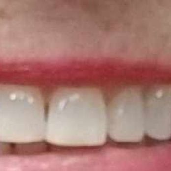 Vacendak Dentistry - They looks sooo Natural,  I was worried they might look like denture teeth...I'm truely thrilled !!!!! - General Dentistry Near Me - Chesapeake, Virginia