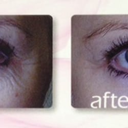 Christine Langell, MD - We offer a wide range of aesthetic eye lid treatments including non-surgical lid lifts using Viora Reaction