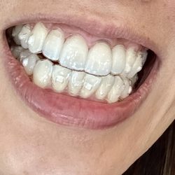 Urban Dental - Invisalign treatment