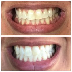 Dental Arts of Sunset - Boost whitening results after only one session!