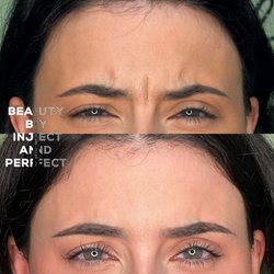 Beautify Botox treatment