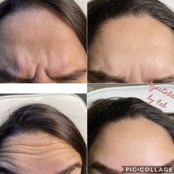 Shore Medical Aesthetics & Anti Aging - Botox by Sandra
