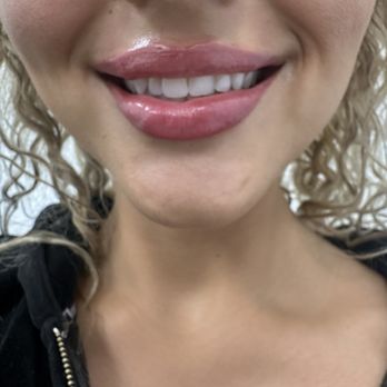 LaserAway - Freshly done Lips by Hana. They are still swollen , so they will smooth out in a couple days. - Medical Spas Near Me - Anaheim, California