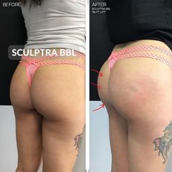 Juvly Aesthetics - Non-surgical Butt Lift With Sculptra