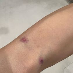 LabCorp - Bruised holes on the arm
