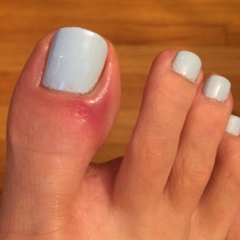 Lamorinda Nails - My beautiful pedicure but still possibly infected toe three days later. Ouch! - Nail Salons Near Me - Lafayette, California