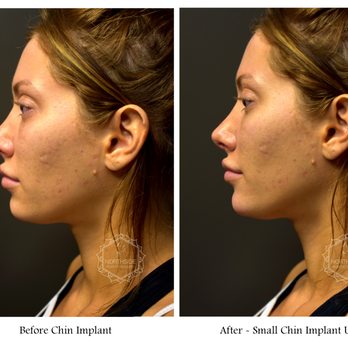 Northside Plastic Surgery - Small Chin Implant - Medical Spas Near Me - Alpharetta, Georgia Northside Plastic Surgery - Small Chin Implant - Medical Spas Near Me - Alpharetta, Georgia