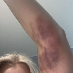 BioLife Plasma Center - Bruise after getting plasma