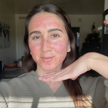 Nirvana Skin - After my first micro needling session! - Skin Care Near Me - Rancho Cucamonga, California