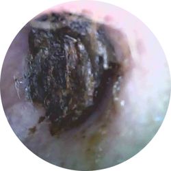 NextCare Urgent Care Victoria - Twin Fountains Drive - Ear occlusion