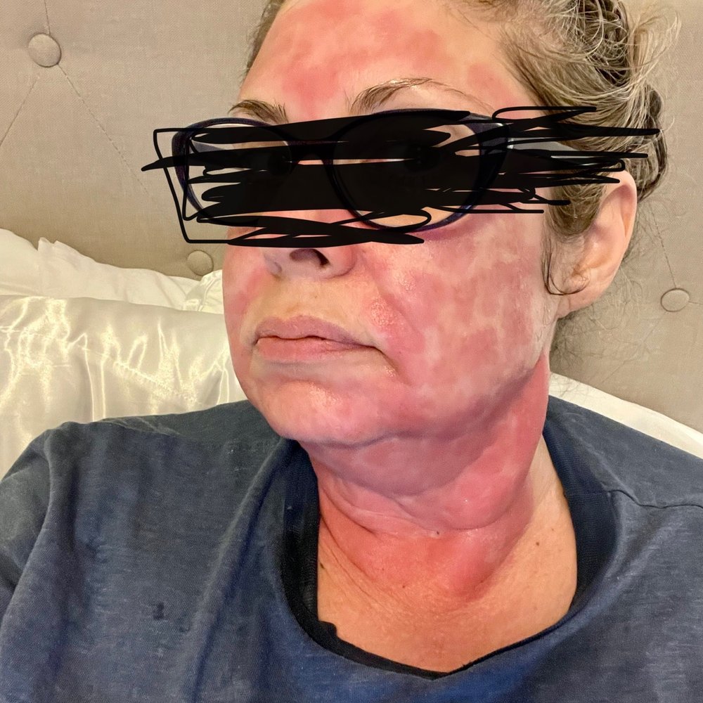 Laser Loft - My face the night of the procedure. - Skin Care Near Me - Ponte Vedra Beach, Florida
