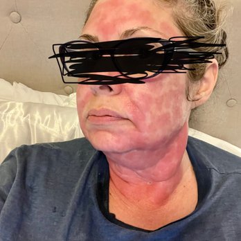 Laser Loft - My face the night of the procedure. - Skin Care Near Me - Ponte Vedra Beach, Florida Laser Loft - My face the night of the procedure. - Skin Care Near Me - Ponte Vedra Beach, Florida