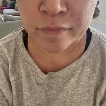 Aaron Kosins, MD - Collapsed (double) valves both inner & outer - Cosmetic Surgeons Near Me - Newport Beach, California
