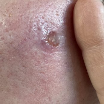 Blackledge Face Center - Left cheek implant tip protruding from my face. I'd mention the pain & unevenness, Blackledge would say 'your brows look great though' - Cosmetic Surgeons Near Me - Jackson, Mississippi