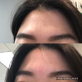 Harvest Acupuncture - Before/After of my most recent visit. - Acupuncture Near Me - Manhasset, New York Harvest Acupuncture - Before/After of my most recent visit. - Acupuncture Near Me - Manhasset, New York