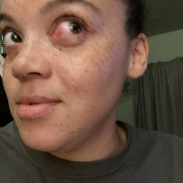 Pinkeye Pinkeye