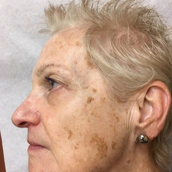 Parvin Shafa, MD - This is my face on my first visit to Dr. Shafa. - Dermatologists Near Me - Irvine, California