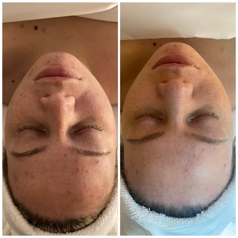 Rewind Skin Spa - Before and after photos - Aestheticians Near Me - Shelby, North Carolina Rewind Skin Spa - Before and after photos - Aestheticians Near Me - Shelby, North Carolina