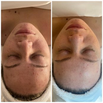 Rewind Skin Spa - Before and after photos - Aestheticians Near Me - Shelby, North Carolina Rewind Skin Spa - Before and after photos - Aestheticians Near Me - Shelby, North Carolina