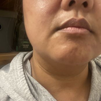 Royal Reflections - Abrasion on left nasal ala!! - Nail Salons Near Me - Concord, North Carolina Royal Reflections - Abrasion on left nasal ala!! - Nail Salons Near Me - Concord, North Carolina
