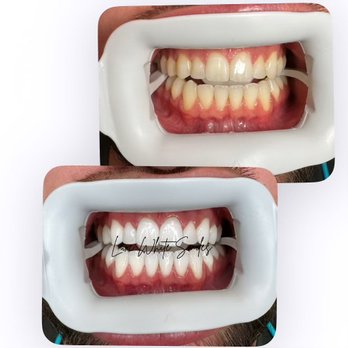 Luxe White Smiles - Teeth Whitening Near Me - Glendale, Arizona