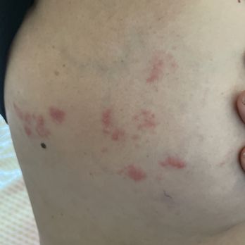 Best Western Bishop Lodge - Here is a picture of her skin after sleeping in these shit hole rooms. - Hotels Near Me - Bishop, California
