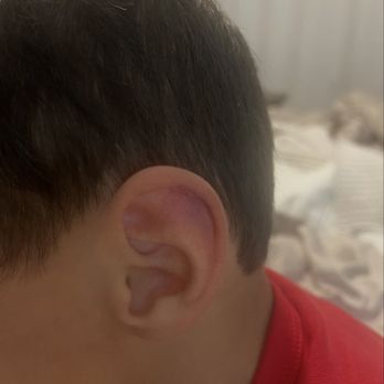 Zion Lutheran - Bruise inside his ear - Child Care & Day Care Near Me - Lodi, California Zion Lutheran - Bruise inside his ear - Child Care & Day Care Near Me - Lodi, California