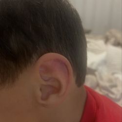 Bruise inside his ear