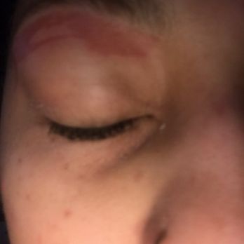 Le's Nails & Spa - Second degree burn from eyebrow wax - Nail Salons Near Me - Duluth, Georgia
