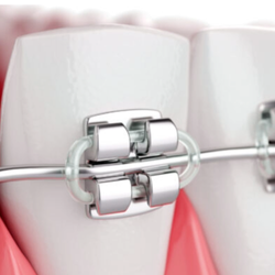 Diamond Braces
