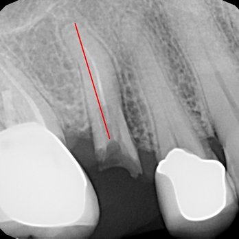 The Wright Dentist - Fractured tooth - Cosmetic Dentists Near Me - Honolulu, Hawaii