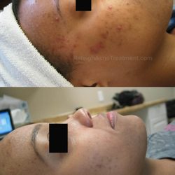 Luminosity Acne Skincare - Acne Treatment - Acne Treatment results at Luminosity Acne Skincare.