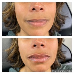 Bliss Health & Wellness - Lip filler