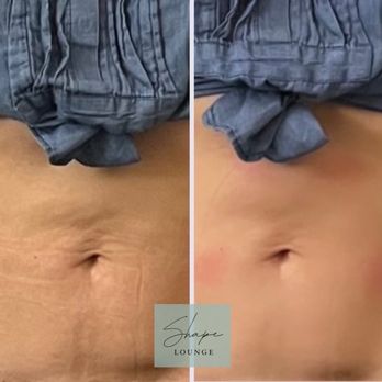 Shape Lounge - After 1 EMS-sculpting pro session - Weight Loss Centers Near Me - Costa Mesa , California