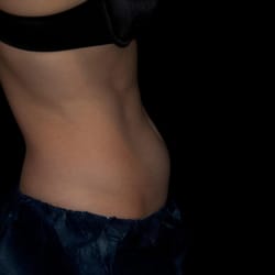 Alan J Liftin MD - Lower abdomen before treatment