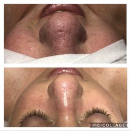 Before and After
