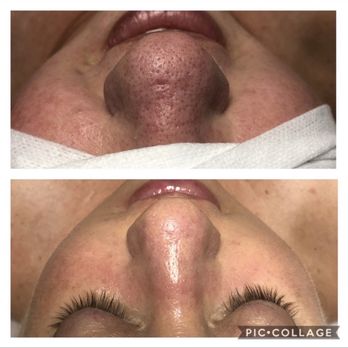 NeoMed - Before and After - Skin Care Near Me - Temecula, California
