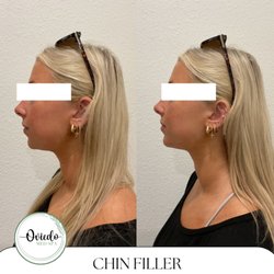 Oviedo Med Spa - Chin Filler