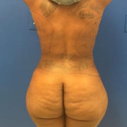 Celebrity Body Sculpting - Liposuction/ Brazilian Butt lift before picture 6/25/16