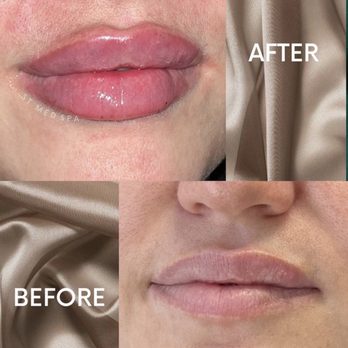 ST Med Spa - Transform your pout with Versa Lips!
Benefits include:
- Provides fullness, volume & hydration
- add projection and symmetry - Medical Spas Near Me - Encino, California ST Med Spa - Transform your pout with Versa Lips!
Benefits include:
- Provides fullness, volume & hydration
- add projection and symmetry - Medical Spas Near Me - Encino, California