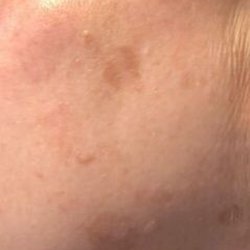 Enlighten Bodhi Spa - After 4 facials (I think) about 3 weeks apart.