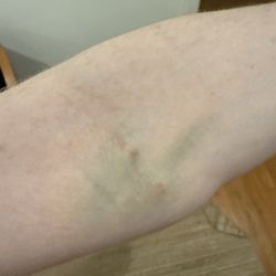 The I.V Doc - The bruising from the injection attempts 1 and 2.
