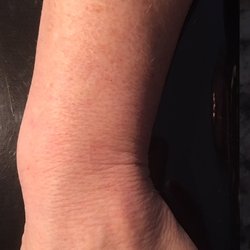 Rask Bart MD - Ulna Bone sticking out