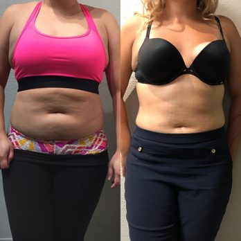 Oluwa Esthetics - Real People! Real Results! Results After 10 Ultrasonic Body Treatments. - Skin Care Near Me - Eureka, California Oluwa Esthetics - Real People! Real Results! Results After 10 Ultrasonic Body Treatments. - Skin Care Near Me - Eureka, California