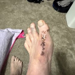 McVay Foot & Ankle - Foot after 2 weeks