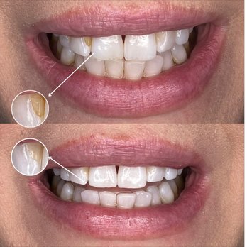 HySmiles - Teeth Whitening Near Me - San Jose, California HySmiles - Teeth Whitening Near Me - San Jose, California