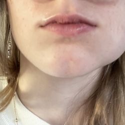 Smilebuilderz - Painful ass lump that he forgot to numb prior to cutting and scraping away in her mouth