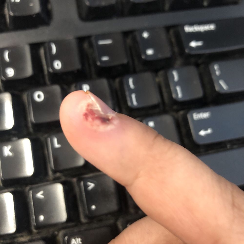 Red Spa Nails - Wart in my finger due to being cut here - Nail Salons Near Me - Brooklyn, New York