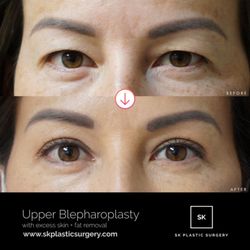 SK Plastic Surgery - This patient underwent upper eyelid incisional blepharoplasty. Excess skin was removed and youthfulness of her eyes restored.